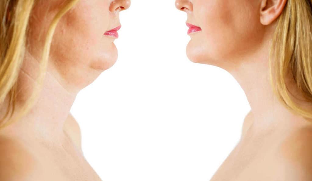 Double Chin treatment Spalding before and after results