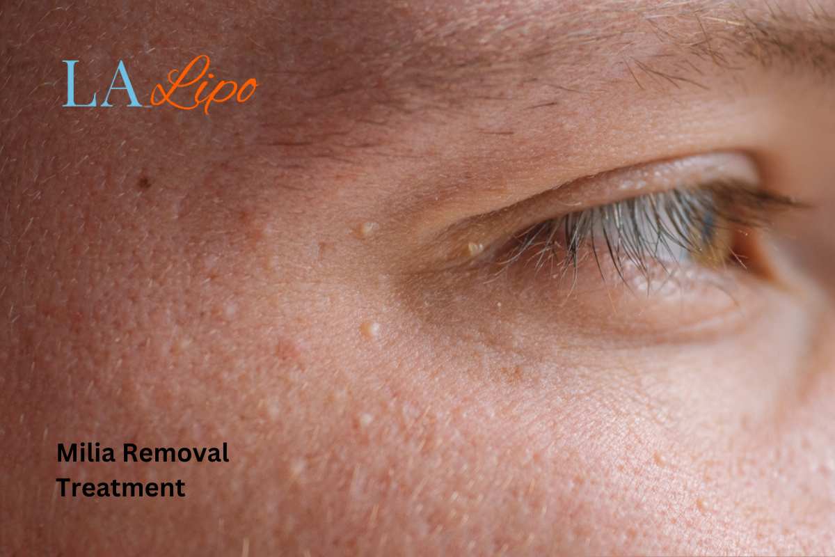 Cryopen Milia Removal: Is It the Easiest and Safest Option Spalding?