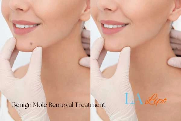 woman's before and after mole removal Spalding results