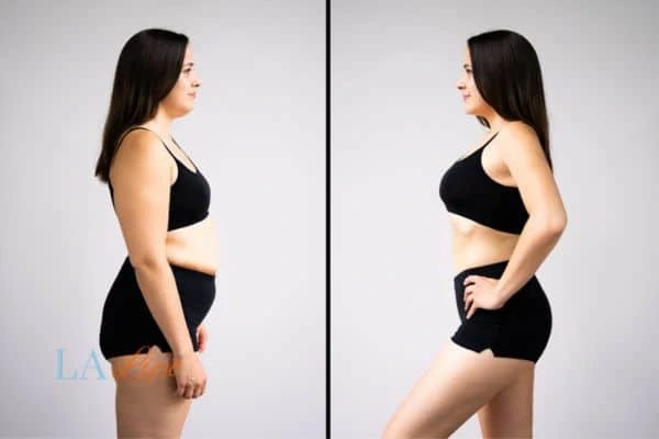 image of woman before and after results of LA-EMS Body Sculpting Spalding to help treat Diastasis recti