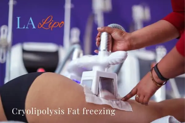 women getting fat freezing Spalding