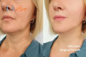hi-fu for wrinkles Spalding before and after results