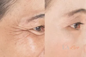Before and after results of woman - HI-fu wrinkles reduction treatment Spalding