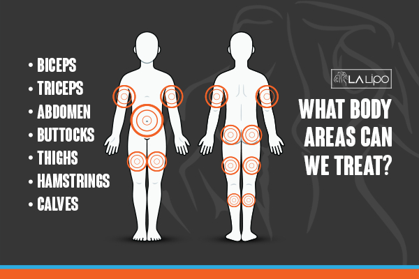 Graphic to show areas you can have LA-EMS Body Sculpting Spalding treatment.