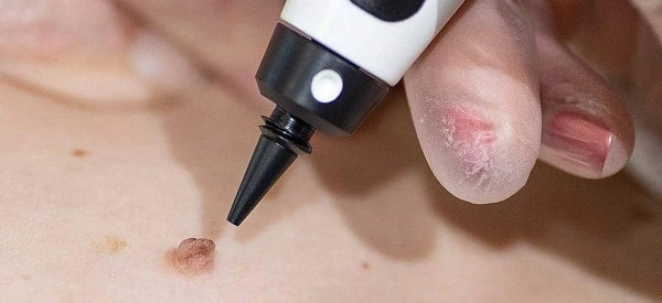skin tag removal using cryopen Spalding