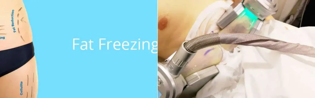 Fat freezing Spalding on multiple areas of the body