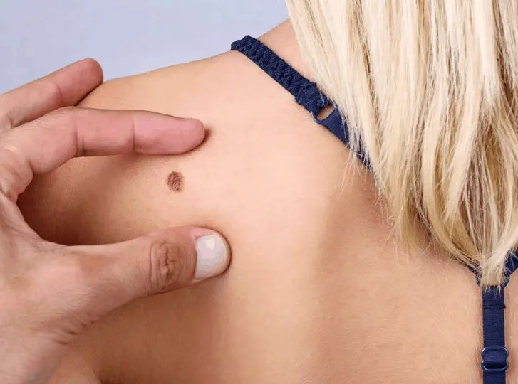 woman having mole removal Spalding consultation before treatment.