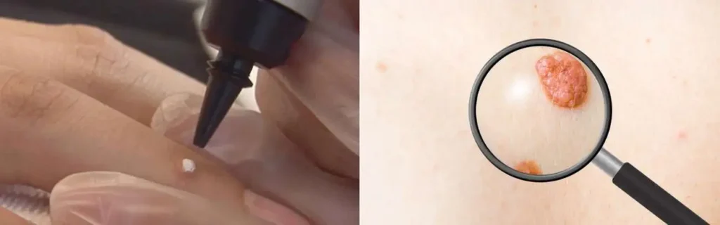 Cryopen for mole removal Spalding - speak to our team today!