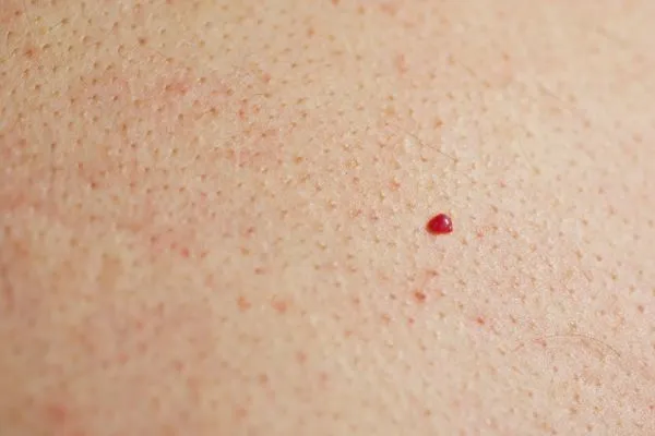 close up of a cherry angioma Spalding