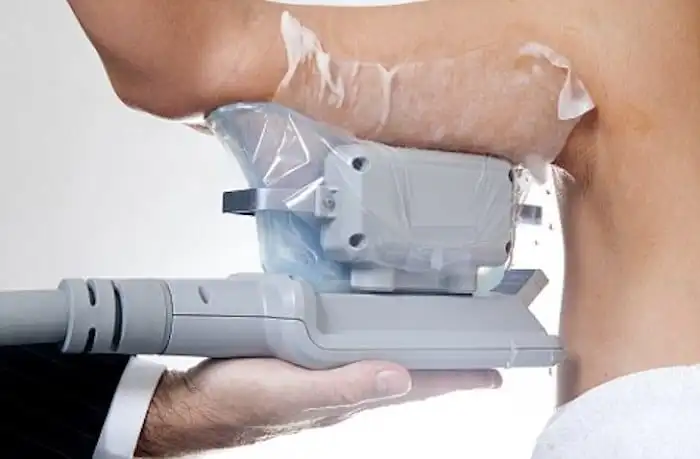 Picture of fat freezing Spalding on the upper arms.