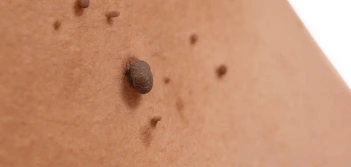 image of a skin tag Spalding