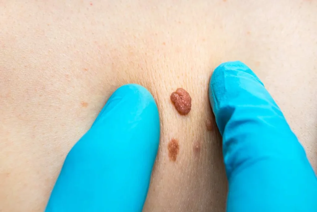 Consultant examining a skin tag Spalding