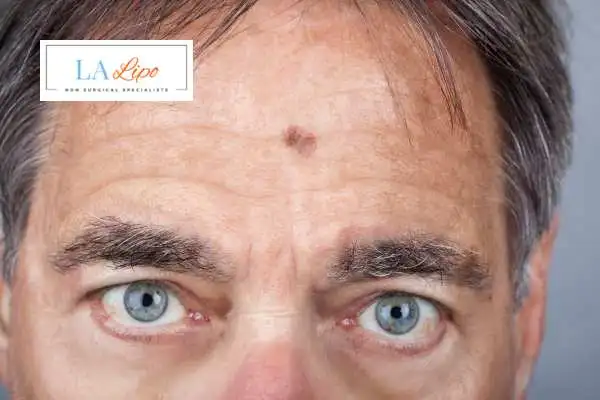 Solar Lentigo Removal Spalding image of man with mark on his forehead