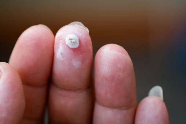wart on person finger - cryotherapy to treat from LA LIPO Spalding