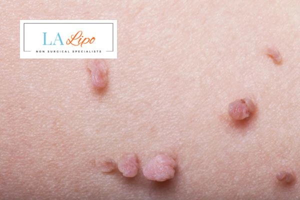 Does cryopen skin tag removal Spalding hurt? Find out now call our team today!