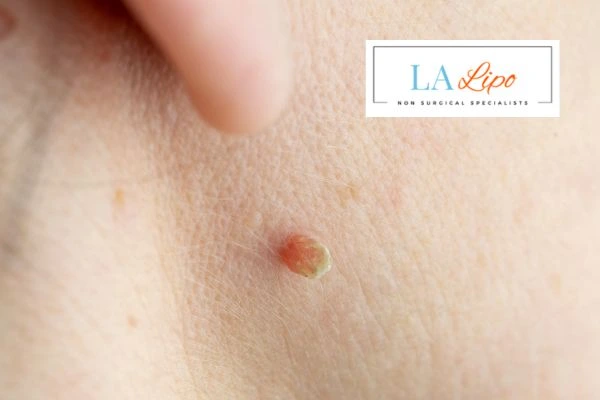 Book skin tag removal Spalding today speak to our team now!