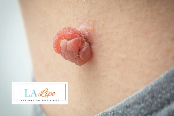 Interested in skin tag removal Spalding? Concerned about the pain? Find out more today!