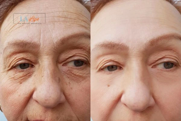 The powerful benefits of Morpheus8 Treatment Spalding - Call Our team today!