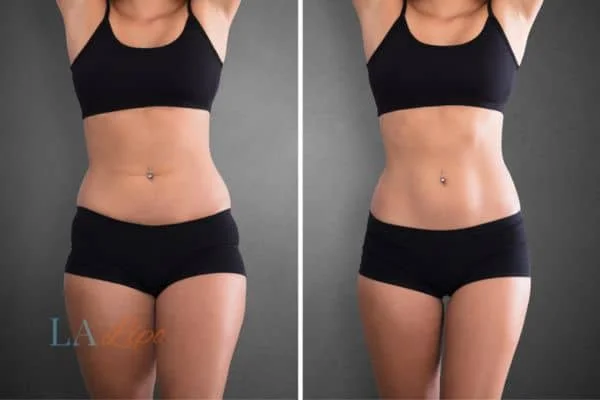 before and after results of non-surgical treatment to help a woman's body image and mental health Spalding