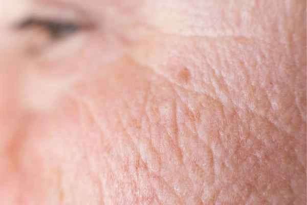 close up picture of a woman's face showing an age spot Spalding