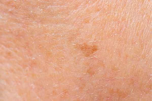close up picture of age spots Spalding