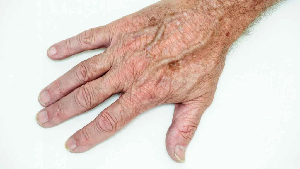 Male hand showing age spot Spalding
