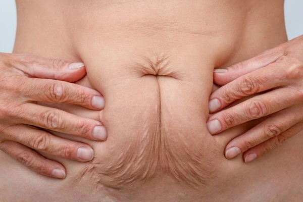 Should I Combine Diastasis Recti Treatment with Body Contouring for Better Results Spalding?