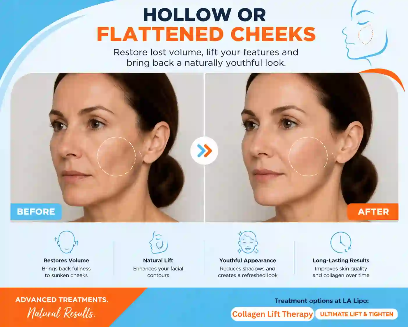 Sign #4: Hollow or Flattened Cheeks Spalding
