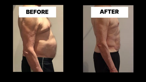 What Symptoms Can Diastasis Recti Cause in Men? Weak Core, Back Pain and Poor Posture Spalding
